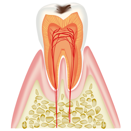 C1:エナメル質内のむし歯