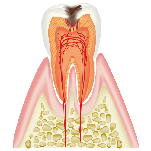 C2:象牙質に達したむし歯