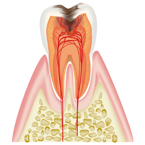 C3:歯髄(神経)に達したむし歯