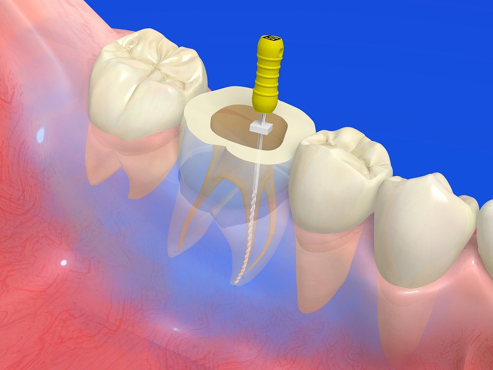 大切な歯を守るための根管治療