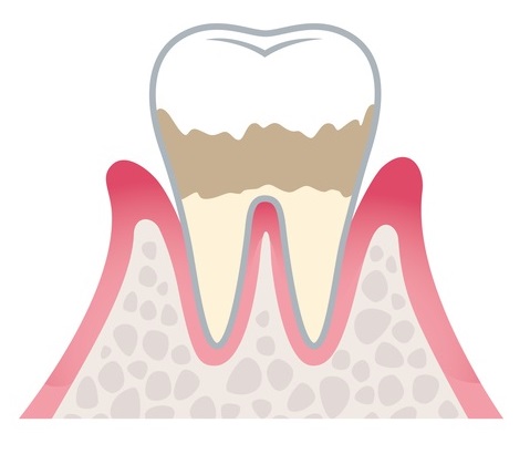 軽度歯周病（歯肉炎・歯周炎）の場合