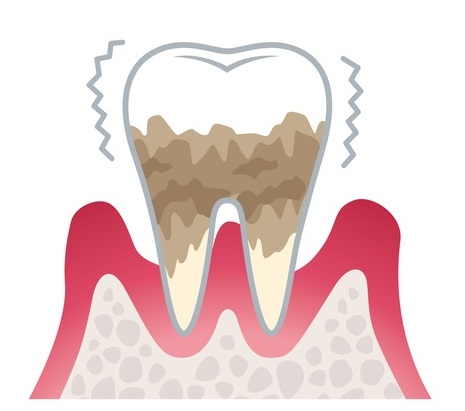 重度歯周病（歯周炎）の場合